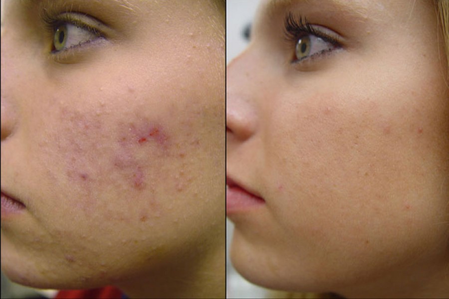 Facing problems with Acne?