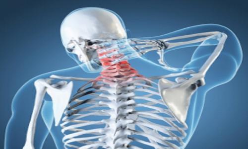 Signs and symptoms of arthritis of the neck