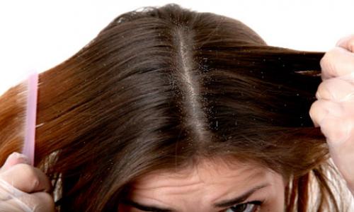 How to cure your dandruff naturally?